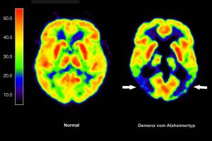 Alzheimer-Erkrankung