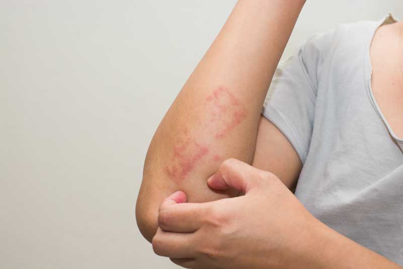 Reinigungsmittel können Hautekzeme verursachen