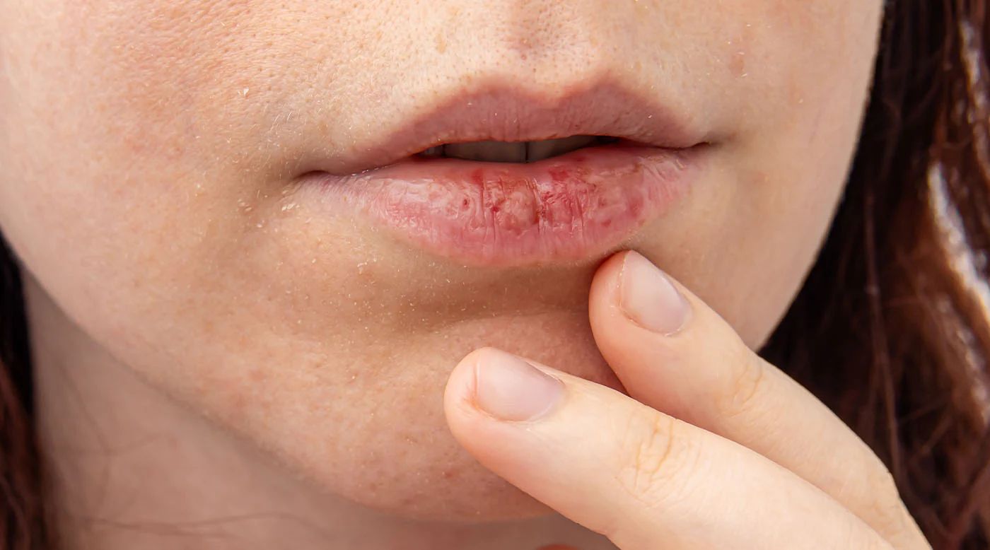 Trockener Mund im Frühling? Das steckt wirklich dahinter