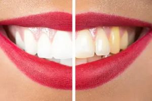 Gelbe Zähne vermeiden: Ursachen verstehen, Verfärbungen sanft vorbeugen