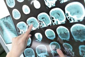 Neue Hoffnung bei MS: Bluttest erkennt Risiko Jahre vor dem Ausbruch