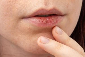 Trockener Mund im Frühling? Das steckt wirklich dahinter