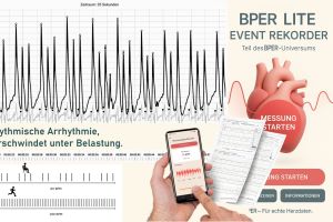 Warum bper.lite einen einstellbaren Arrhythmie-Detektor braucht