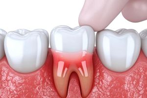 Zahnwurzelentzündung früh erkennen und richtig handeln